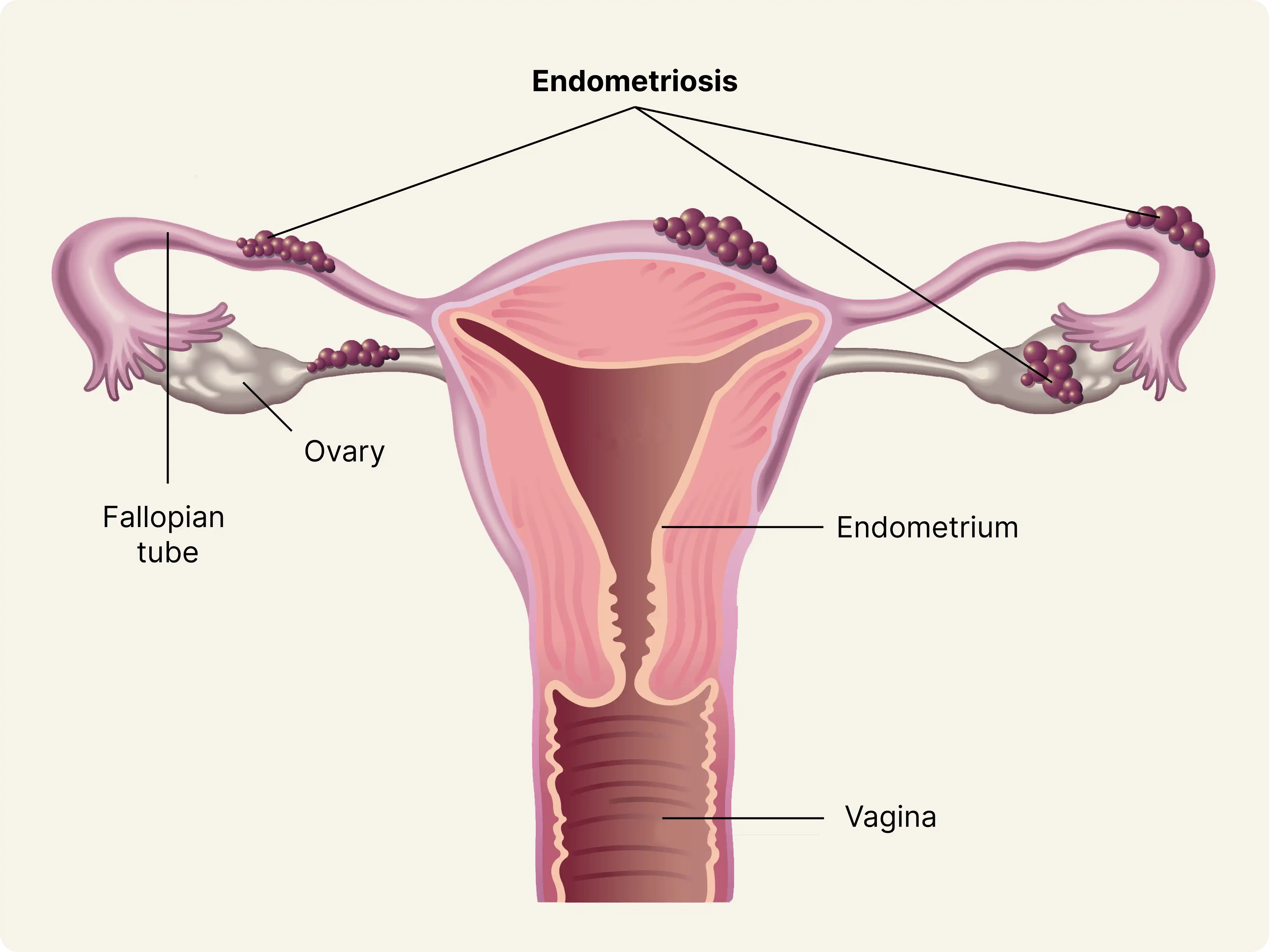 Womb and Fallopian Tube Treatment